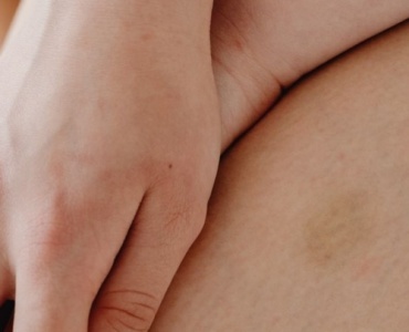 Łojotokowe zapalenie skóry? Postaw na naturę: domowe rytuały i składniki, które działają